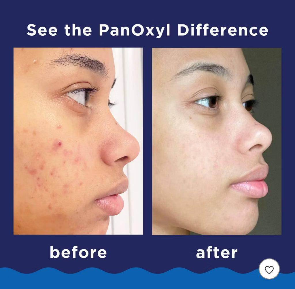 PanOxyl Benzoyl Peroxide Acne Foaming Wash Travel Size - 1oz
