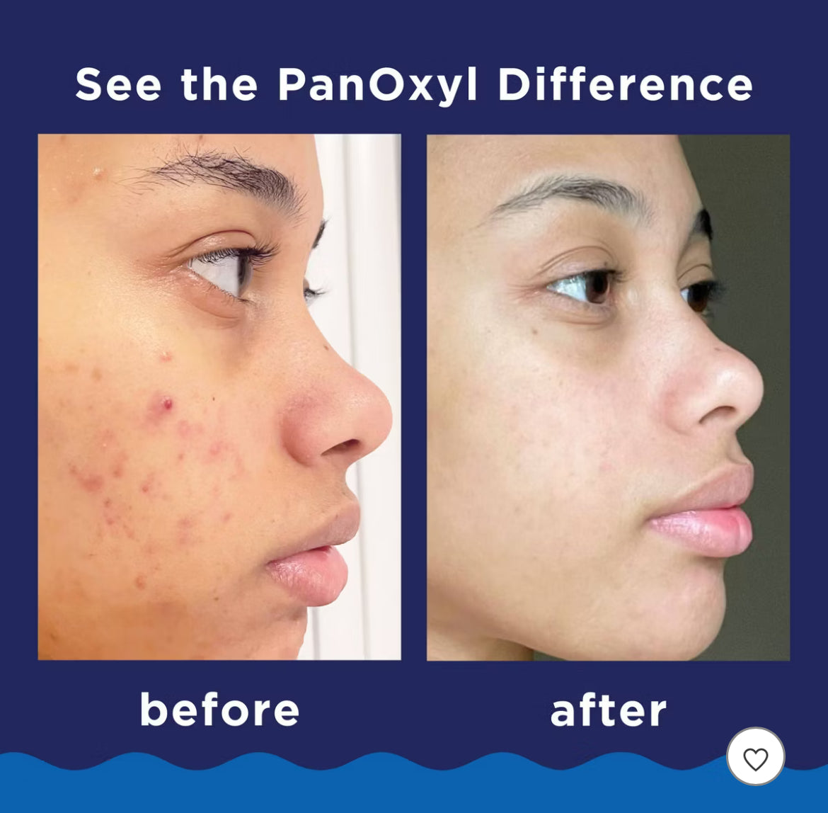 PanOxyl Benzoyl Peroxide Acne Foaming Wash Travel Size - 1oz